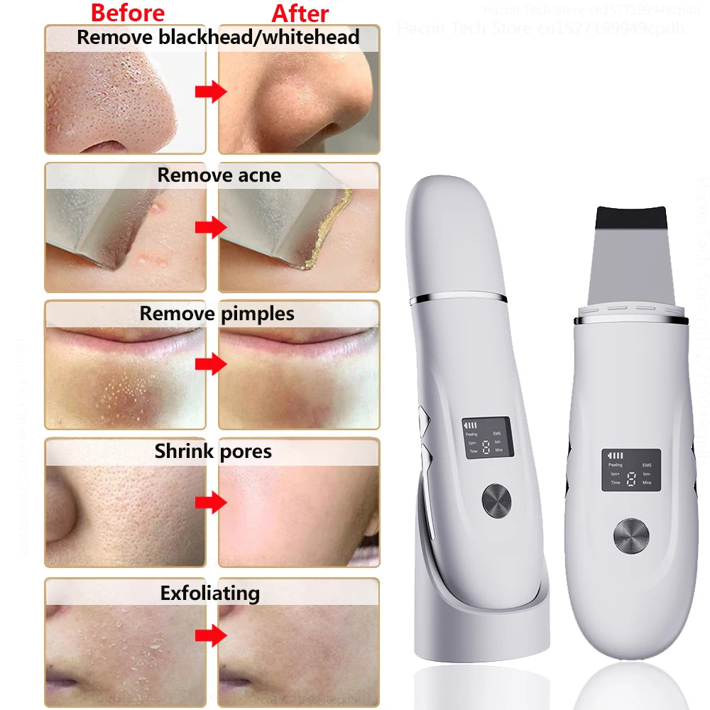 WholesomeHavens™ - Ultrasonic Peeling Remover